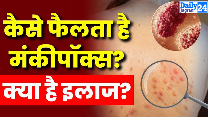 How Does Monkey Pox Spread  भारत मे मंकी पॉक्स  के चार मामले सामने आने के बाद लोगों के बीच दर का माहौल बना हुआ है केरल और दिल्ली के बाद अब तेलंगाना में भी मंकी पॉक्स का संदिग्ध मरीज मिला है